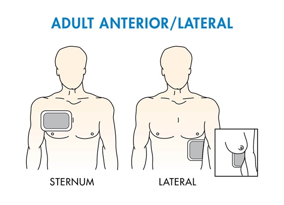 Adult Anterior Lateral Placement