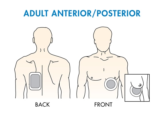 Adult Anterior Posterior Placement