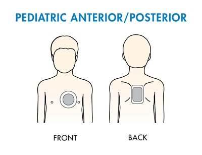 Pediatric Anterior Posterior Placement