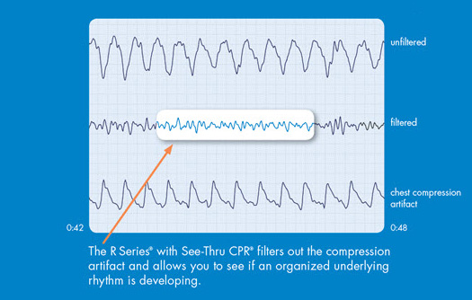 Кривая ЭКГ, полученная с помощью технологии See-thru CPR в высоком разрешении