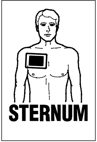 Sternum placement
